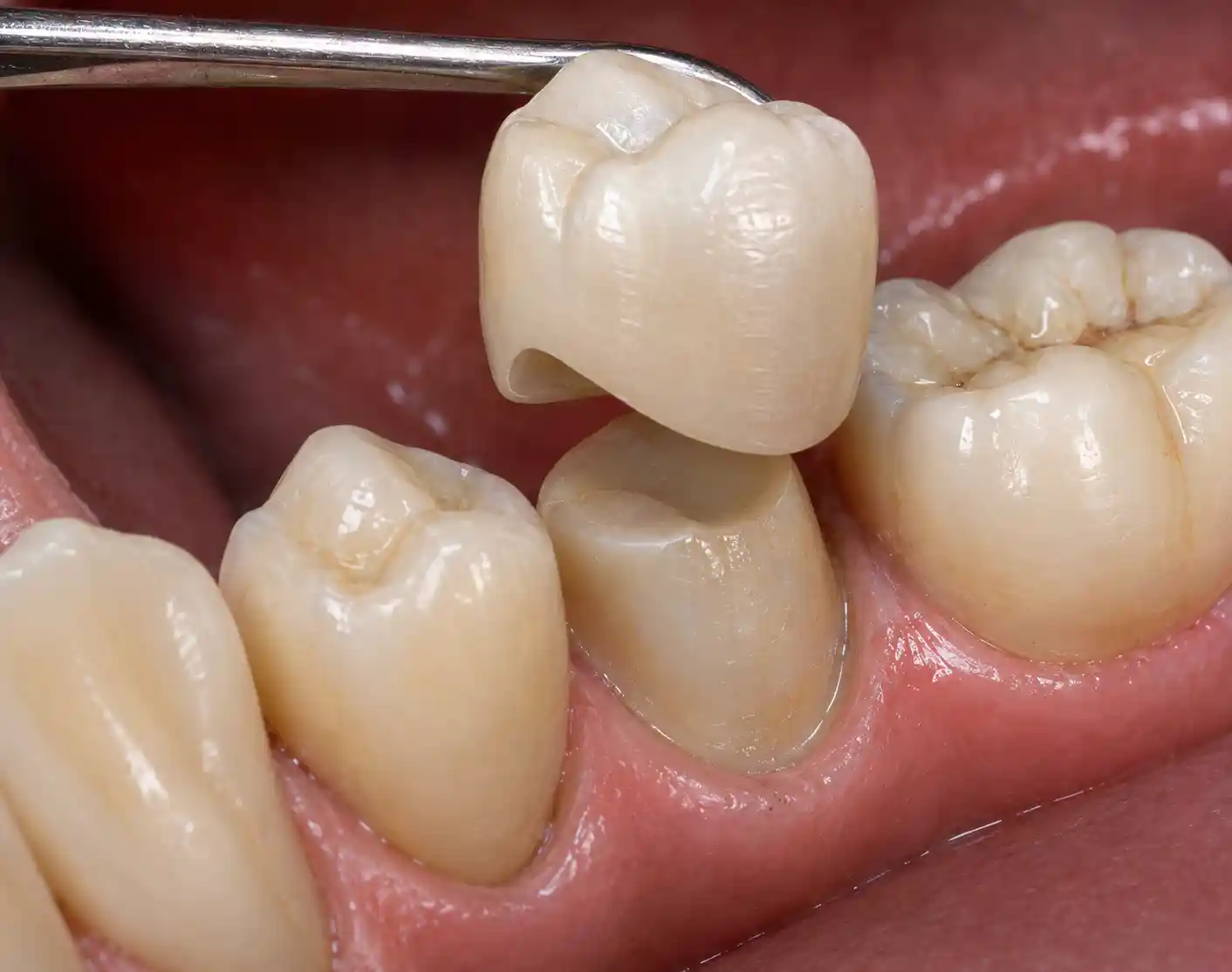 Crowns and bridges treatment room at Radiant 32, Bhowanipore