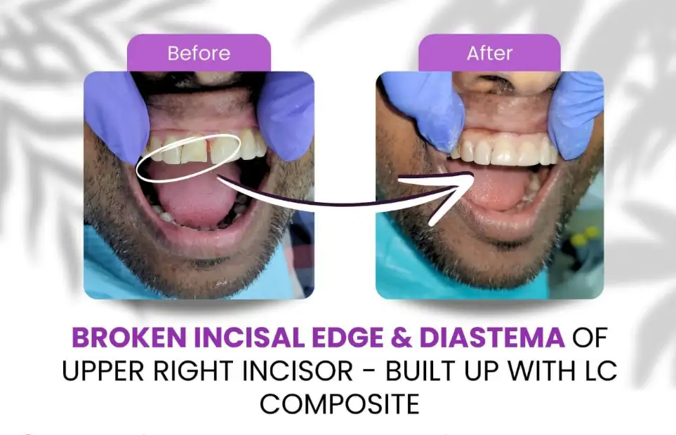 Before and after photo of a broken incisal edge and gap on the upper right incisor repaired with composite bonding