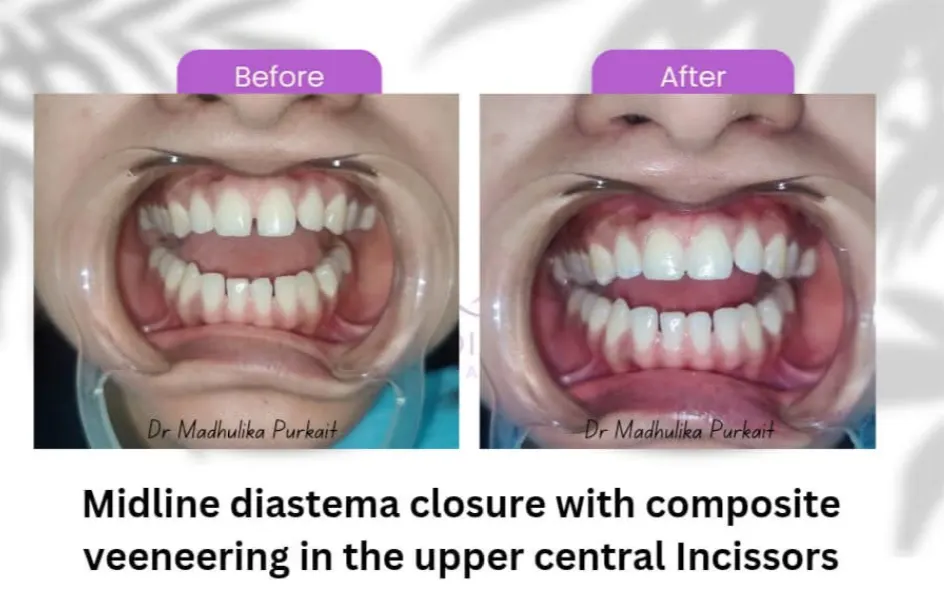 Before and after photo of a midline gap between the upper front teeth closed with composite veneers