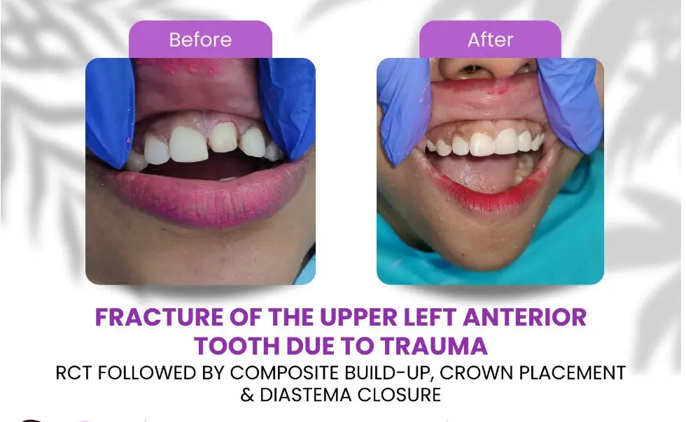 Before and after photo of a midline gap between the upper front teeth closed with composite veneers