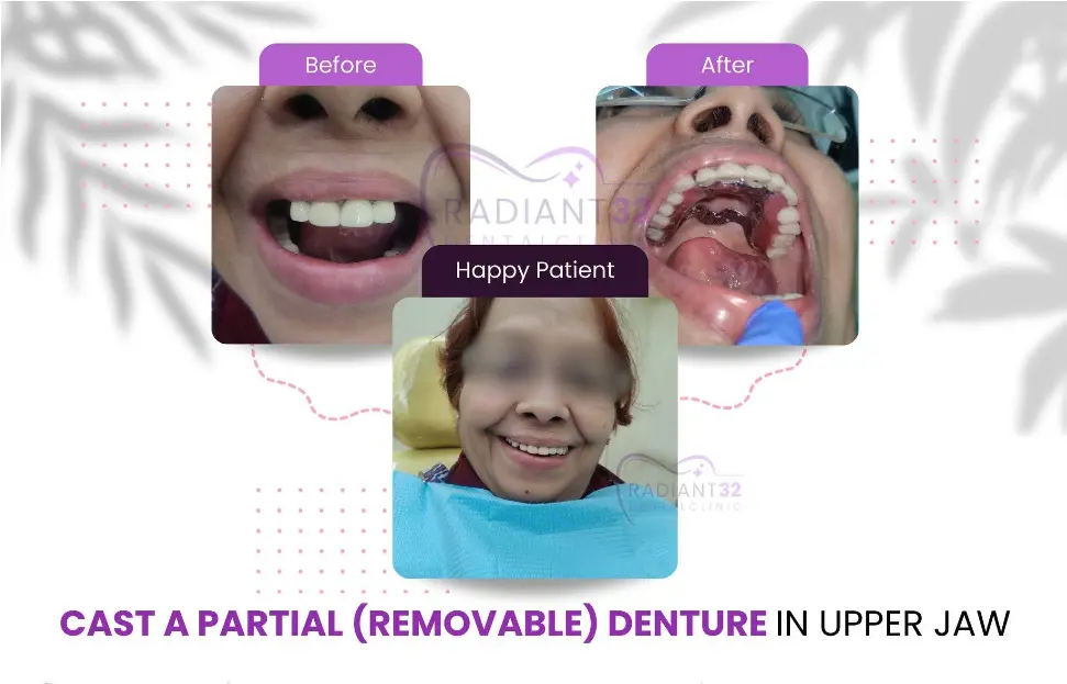 Before and after photo of a midline gap between the upper front teeth closed with composite veneers