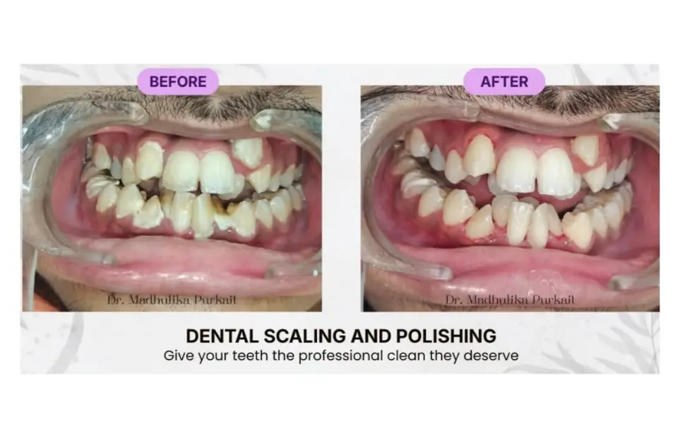 Before and after etween the upper front teeth closed with composite veneers