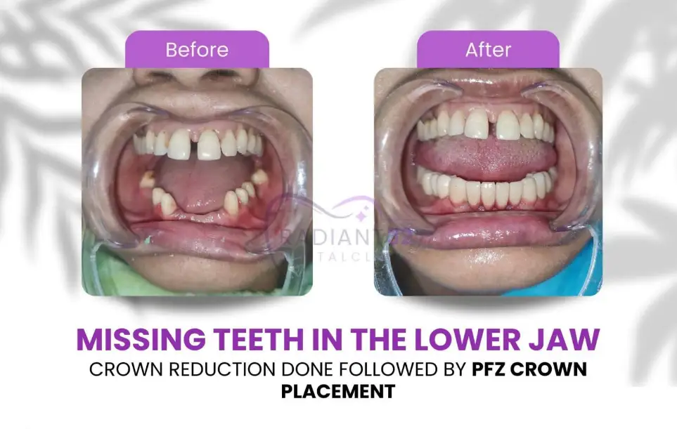Before and after etween the upper front teeth closed with composite veneers