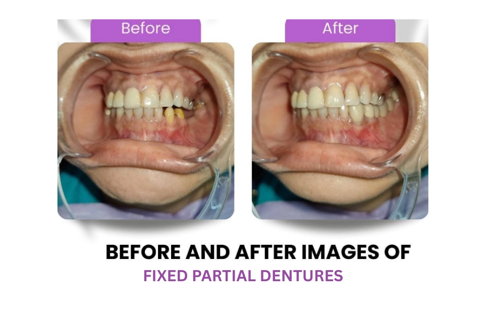 Before and after etween the upper front teeth closed with composite veneers