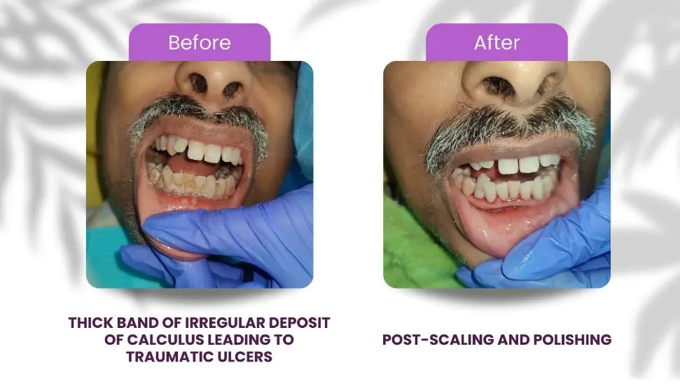 Before and after etween the upper front teeth closed with composite veneers