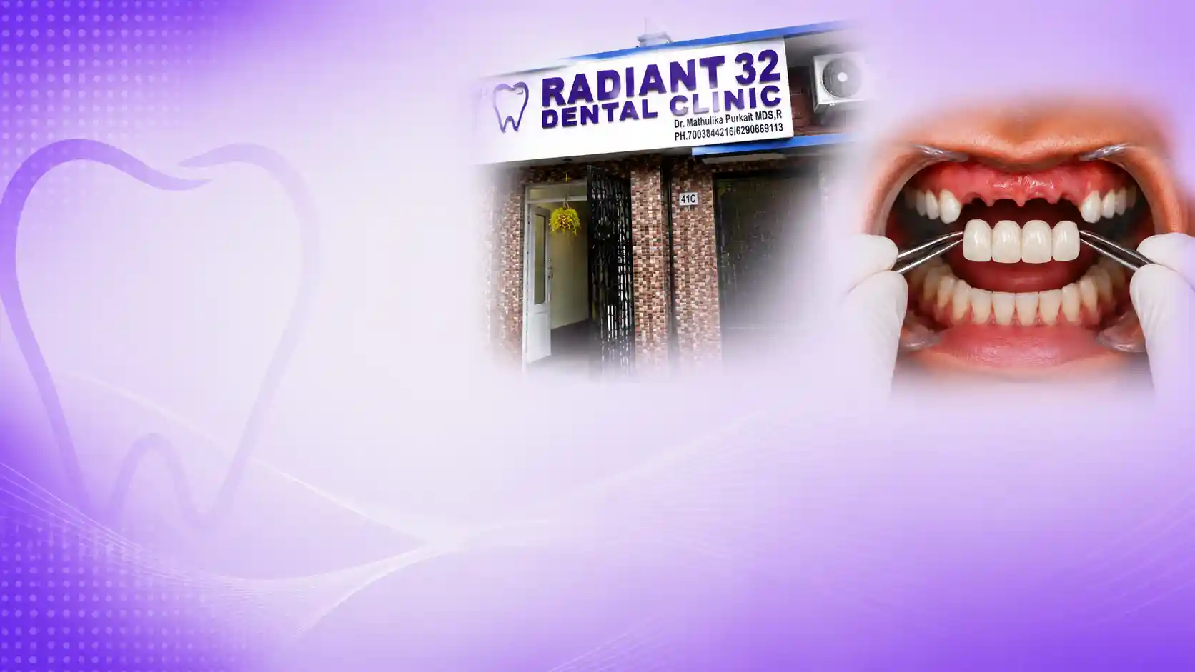 Crown and bridge work prepared at Radiant 32, Bhowanipore