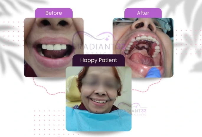 Denture consultation at Radiant 32, Bhowanipore
