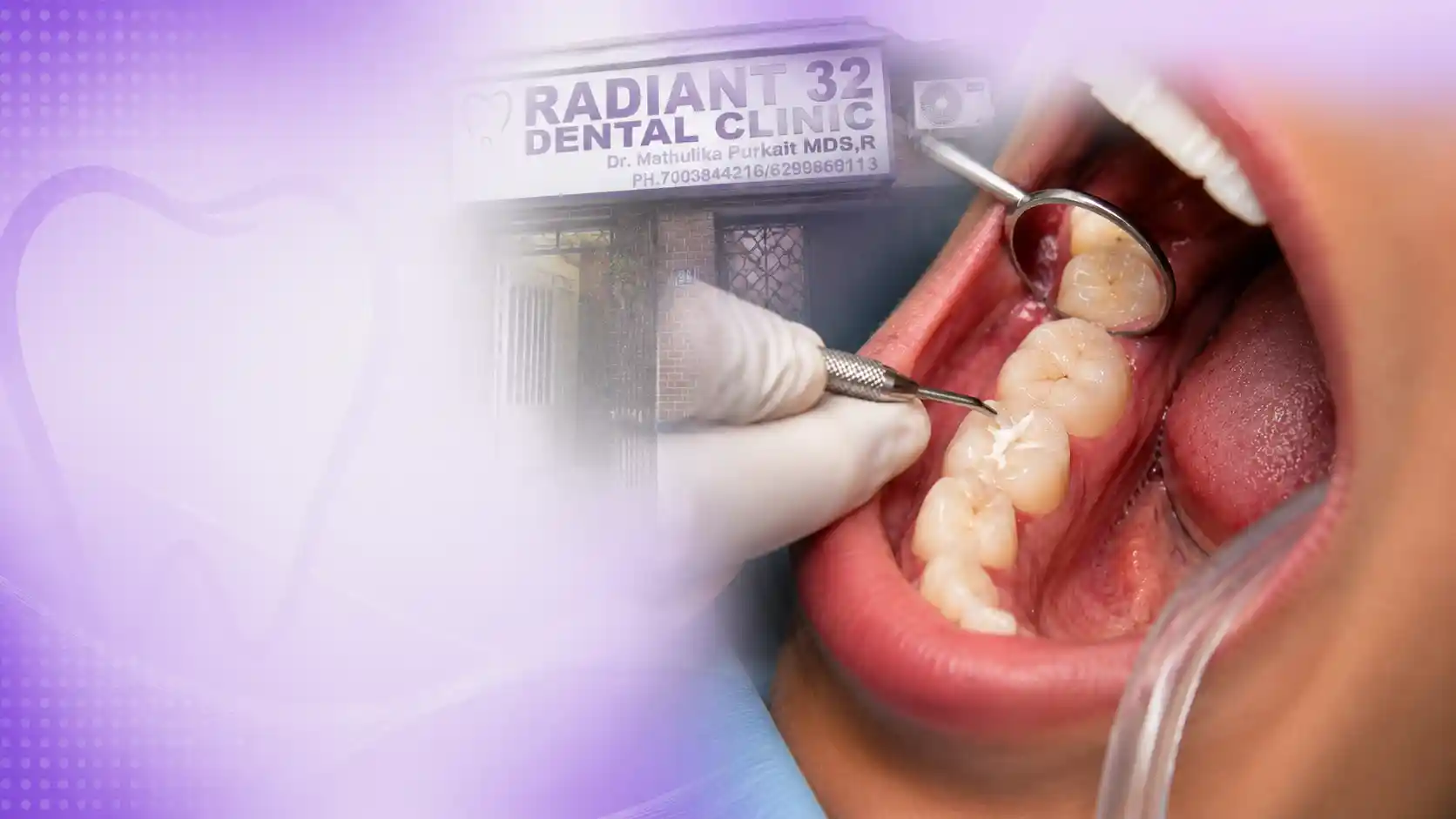 Fillings and sealants procedure prepared at Radiant 32, Bhowanipore