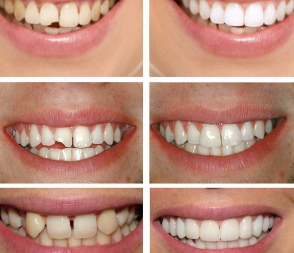 Before and after view of a gap between the front teeth closed at Radiant32 Dental Clinic