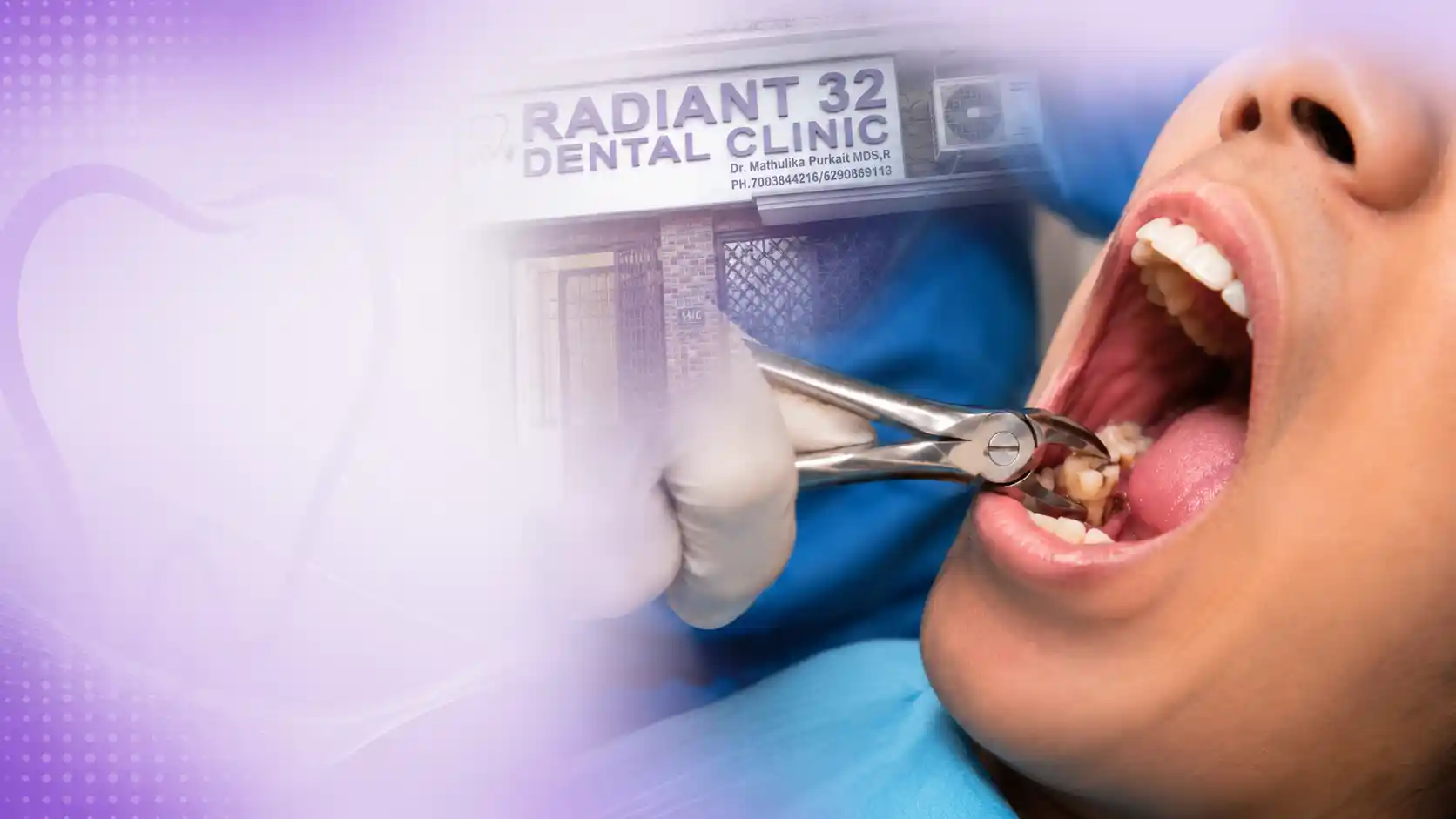 Tooth extraction procedure prepared at Radiant 32, Bhowanipore