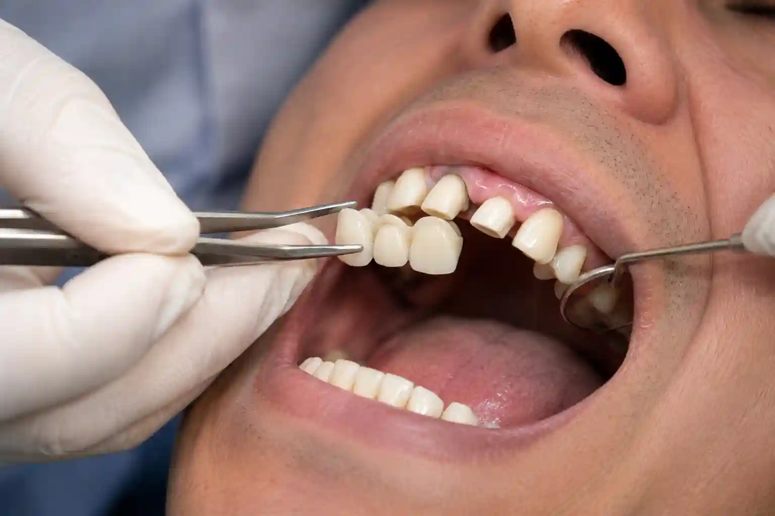 Crowns and bridges