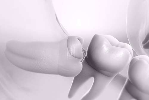 wisdomtooth_extractions