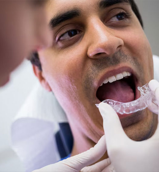 Tooth braces aligners
