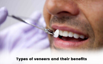Types of Veneers and their benefits