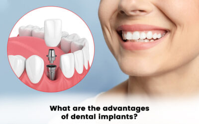 What are the advantages of Dental Implants?