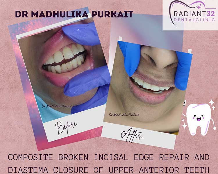 Composite-broken-tooth-repair-and-diastema-closure-home
