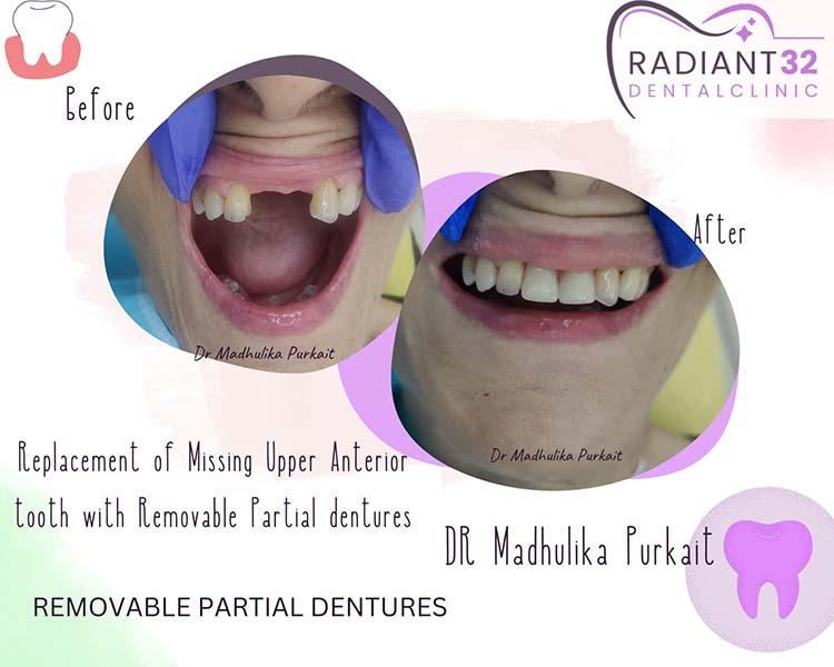 Removable-partial-denture-home