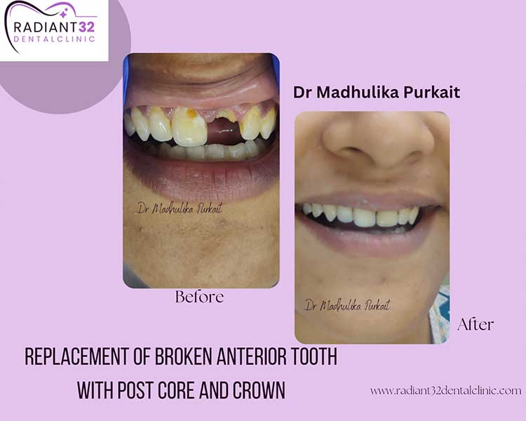 Replacement-of-broken-anterior-tooth-with-post-core-and-crown-home